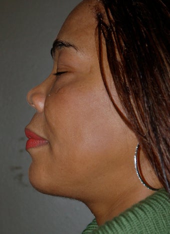 Chin Surgery, Chin Augmentation, Double Chin after 224962