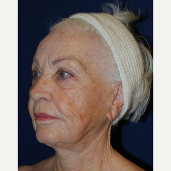 75 and up year old woman treated with Facelift before 3370702