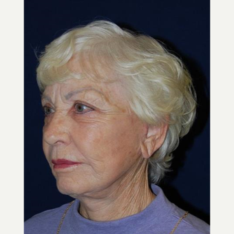 75 and up year old woman treated with Facelift after 3370702