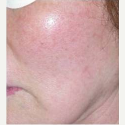 55-64 year old woman treated with Skin Rejuvenation after 3447802