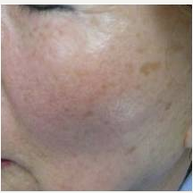 55-64 year old woman treated with Skin Rejuvenation before 3447802