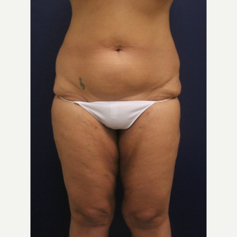 45-54 year old woman treated with Smart Lipo after 3237052