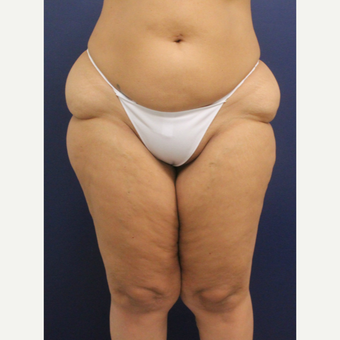 45-54 year old woman treated with Smart Lipo before 3237052