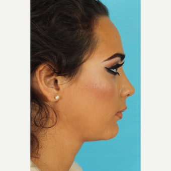 25-34 year old woman treated with Rhinoplasty after 3618326