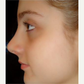 18-24 year old woman treated with Rhinoplasty after 3687045