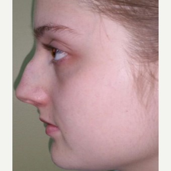 18-24 year old woman treated with Rhinoplasty before 3687045