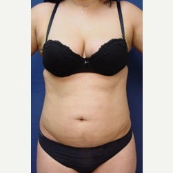 25-34 year old woman treated with Mini Tummy Tuck before 2045402
