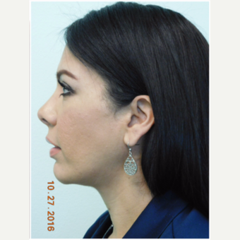 35-45 year old woman treated with Chin Implant and Neck Liposuction after 3670320