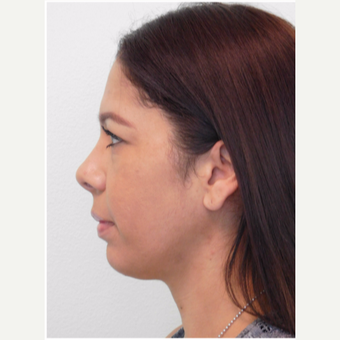35-45 year old woman treated with Chin Implant and Neck Liposuction before 3670320