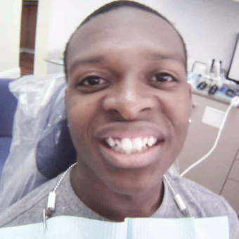 18-24 year old man treated with Dental Crown before 3163867