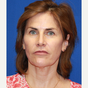 56 year old woman treated with Facelift, neck lift, fat transfer, upper eyelids and CO2 laser skin before 3135204