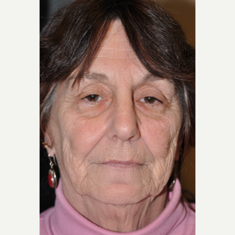 65-74 year old woman treated with Facelift before 3508717