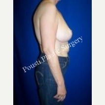 55-64 year old woman treated with Breast Augmentation 1538609