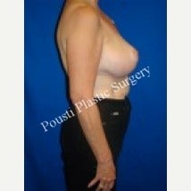 55-64 year old woman treated with Breast Augmentation 1538609