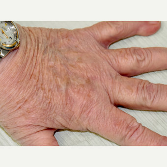 65-74 year old woman treated with IPL after 3295307