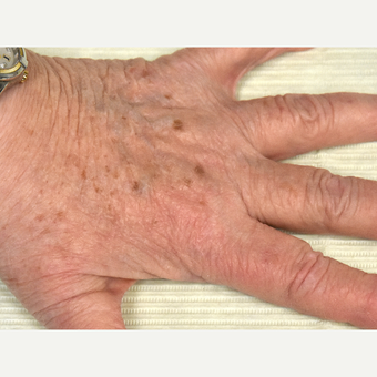 65-74 year old woman treated with IPL before 3295307