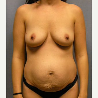 25-34 year old woman treated with Mommy Makeover before 3174650