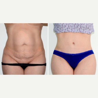 35-44 year old woman treated with full Tummy Tuck, muscle repair + lipo before 2008413