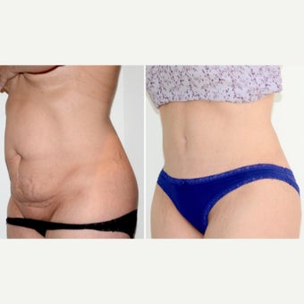 35-44 year old woman treated with full Tummy Tuck, muscle repair + lipo after 2008413
