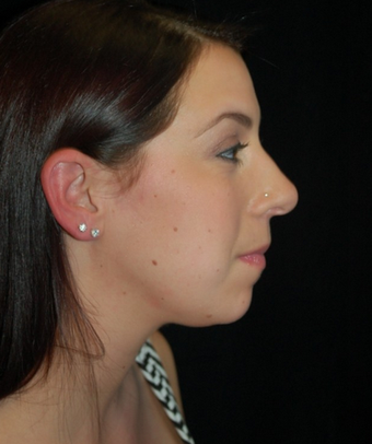 Chin Surgery before 1252689