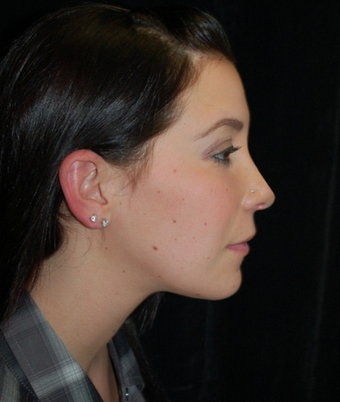 Chin Surgery after 1252689