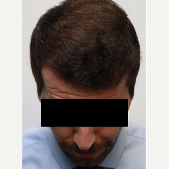 35-44 year old man treated with Organic Hair Transplant after 3172531