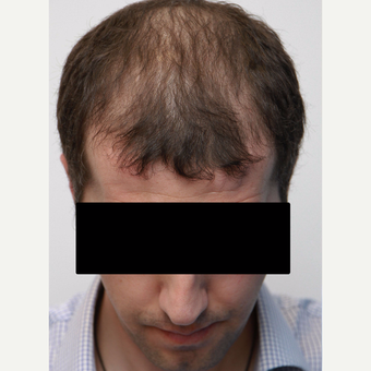35-44 year old man treated with Organic Hair Transplant before 3172531