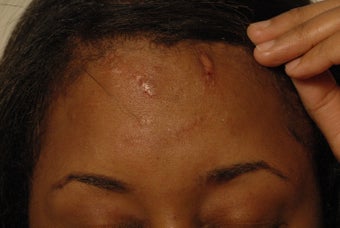 Profractional Laser Resurfacing for Scars - Before and After Photos before 1058733