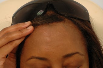 Profractional Laser Resurfacing for Scars - Before and After Photos after 1058733