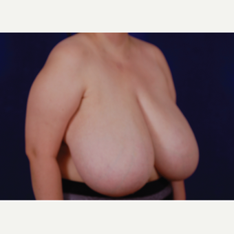 35-44 year old woman treated with Breast Reduction before 3439241