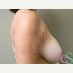 Breast Reduction before 3373573