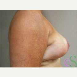 Breast Reduction after 3373573