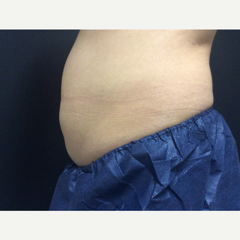 35-44 year old woman treated with CoolSculpting before 3382728