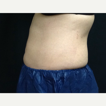 35-44 year old woman treated with CoolSculpting after 3382728