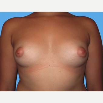 Breast Lift with Implants before 3748783