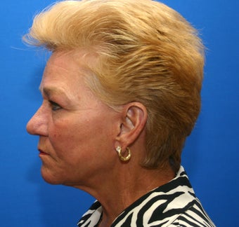 Revision facelift with lower lid blepharoplasty and lateral canthopexy 551194