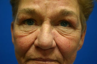 Revision facelift with lower lid blepharoplasty and lateral canthopexy before 551194