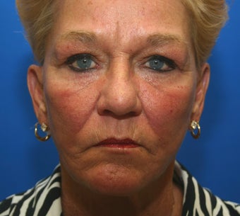 Revision facelift with lower lid blepharoplasty and lateral canthopexy after 551194