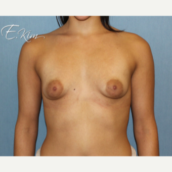 25-34 year old woman treated with Breast Lift before 3663396
