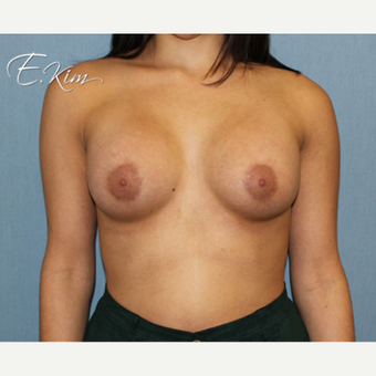 25-34 year old woman treated with Breast Lift after 3663396