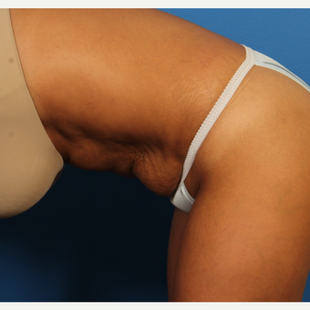 35-44 year old woman treated with Tummy Tuck before 3684807