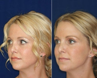 Non-surgical Rhinoplasty before 1224784