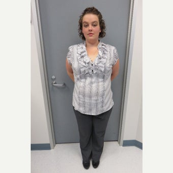 25-34 year old woman treated with Sleeve Gastrectomy after 2562304