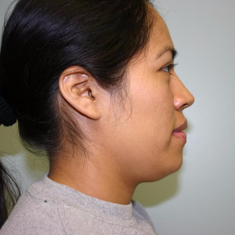 33 year old woman treated with Chin Liposuction before 3442281