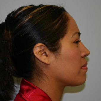 33 year old woman treated with Chin Liposuction after 3442281