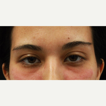 27 year old female treated with Belotero to undereyes before 3104236