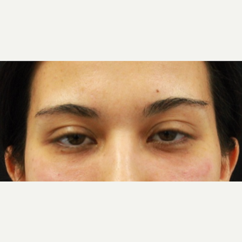 27 year old female treated with Belotero to undereyes after 3104236