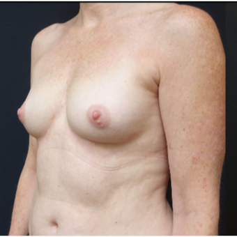 35-44 year old woman treated with Breast Implants before 3529802