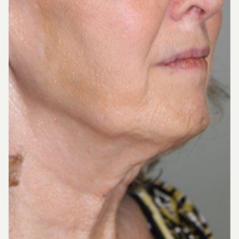 55-64 year old woman treated with Neck Lift before 3370684