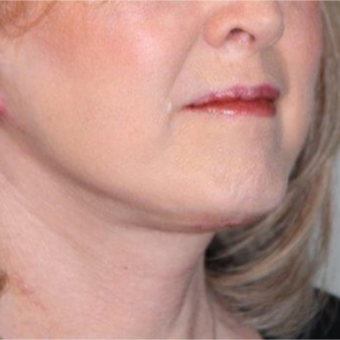 55-64 year old woman treated with Neck Lift after 3370684